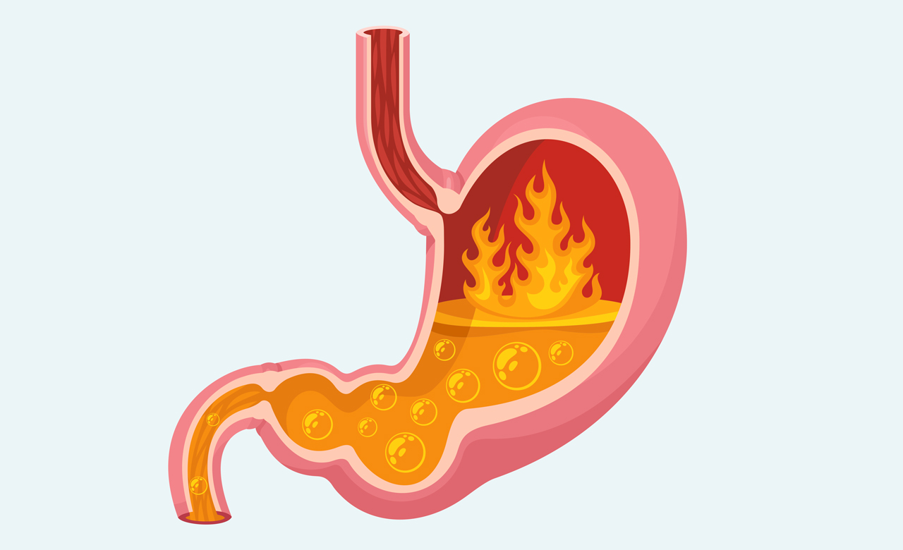 Cartoon illustration of a stomach filled with flames and volatile liquid.