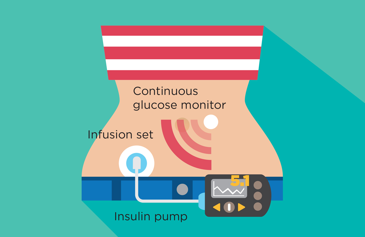 Insulin in Diabetes Care 