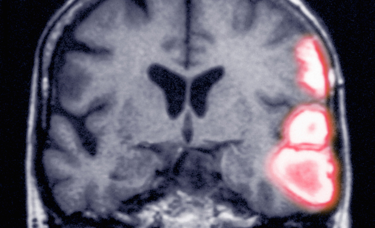 A brain scan showing a hemorrhage 