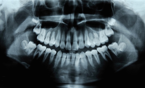 The jaw-dropping truth about medication-related osteonecrosis of the jaws